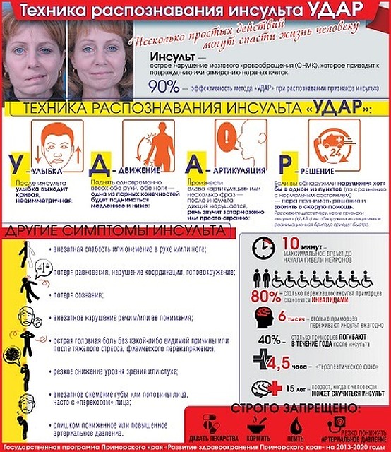 Узнайте, какими бывают симптомы инсульта