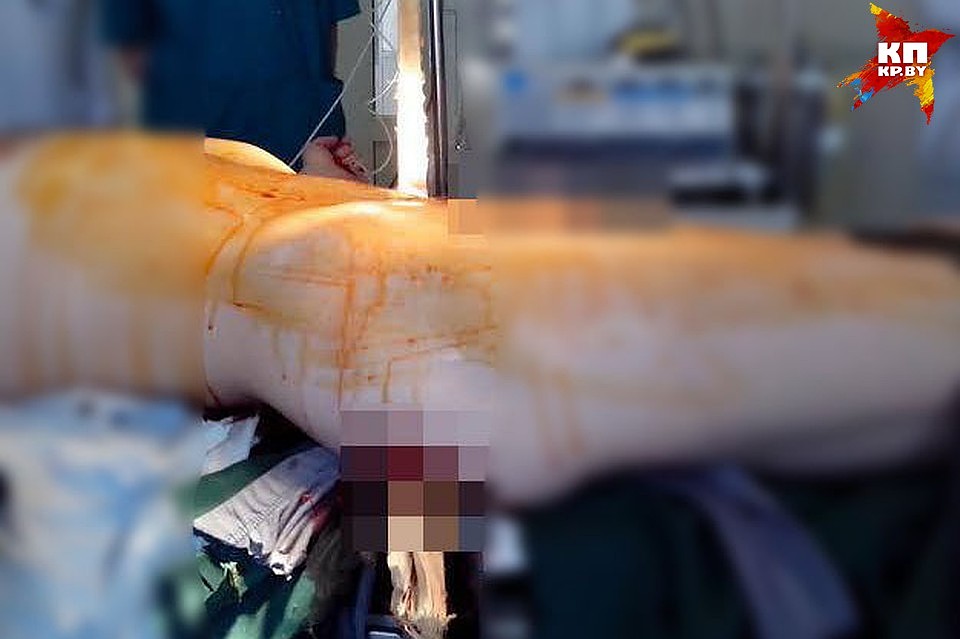 19 марта 2015 года с Андреем из Гродно произошел жуткий несчастный случай на производстве. Фото:архив Гродненской городской клинической больницы №4