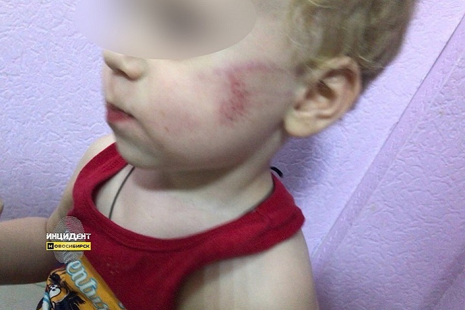 На лице у ребенка синяки. Фото: vk.com/incident_nsk