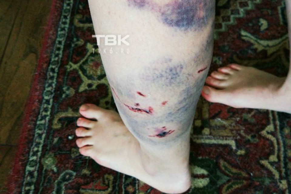 У девочки искусаны ноги и рука Фото: ТВК