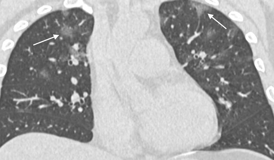 Фото: Cardiothoracic Imaging Division, Department of Radiology Perelman School of Medicine of the University of Pennsylvania