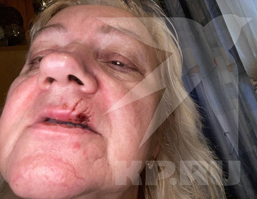 Хозяйка, пытаясь спасти редкого питомца, тоже пострадала от зубов зверя