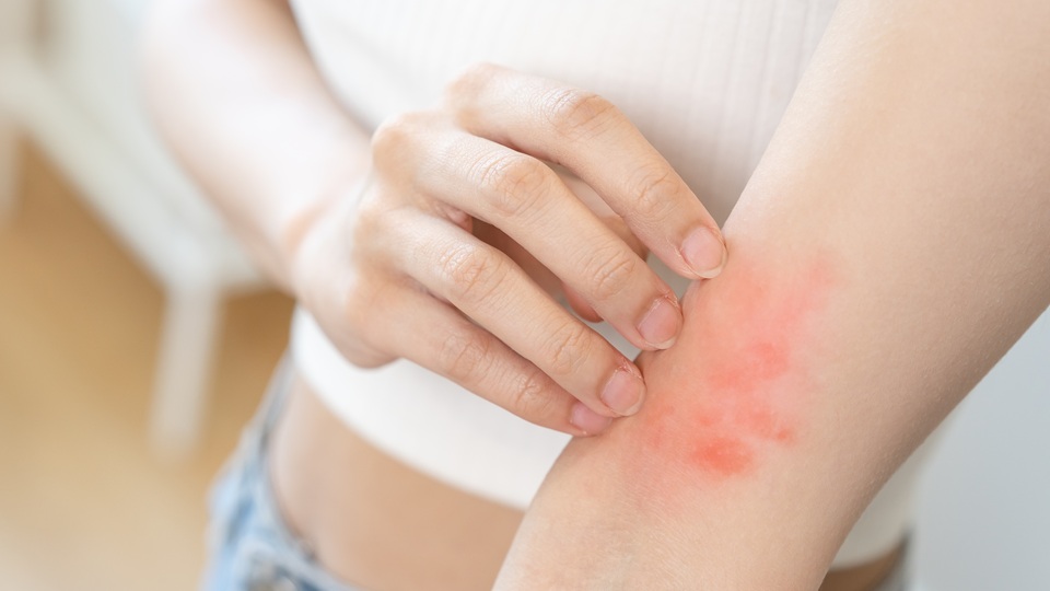 Аллергия на руках у взрослых
