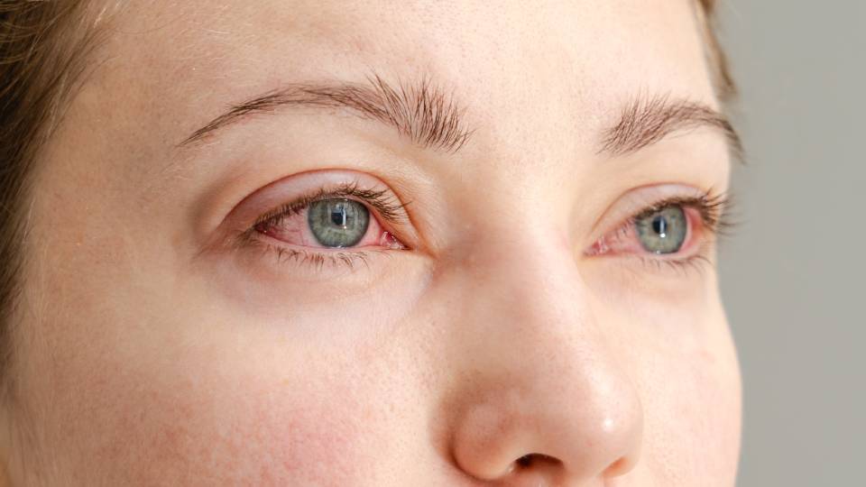 Покраснение глаз